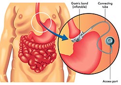 Bariatric Surgical Procedures (Weight-Loss Surgery