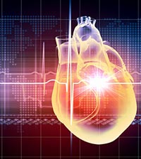 Coronary Bypass Surgery (CABG)