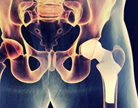 Hip Endoprosthesis Surgery 